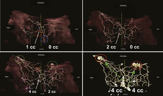Three-dimensional computed tomographic angiography analysis. Top-left image: flap no. 1, right PSAP = 1 mL, left PSAP = 0 mL. Yellow dashed line, midline; blue circle, left PSAP; red circle, right PSAP. Top-right image: flap no. 1, right PSAP = 2 mL, left PSAP = 0 mL. Yellow dashed lines, midline. Contrast medium diffusion is visualized crossing the midline to the contralateral side. Bottom-left image: flap no. 1, right PSAP = 4 mL, left PSAP = 2 mL. On the right, the network is overloaded, whereas on the left, the product is progressing. The perforasome of the injected PSAPs supply adjacent perforasomes. Green circles, lumbar perforators; purple circles, upper gluteal perforators; red circles, other PSAPs. Bottom-right image: flap no. 1, right PSAP = 4 mL, left PSAP = 4 mL. Both networks are overloaded under controlled pressure. The red circle shows leaks of contrast medium. The green arrows are the direction of flow preferentially directed upwards and outwards (dominant linking vessels). PSAP, parasacral artery perforator.