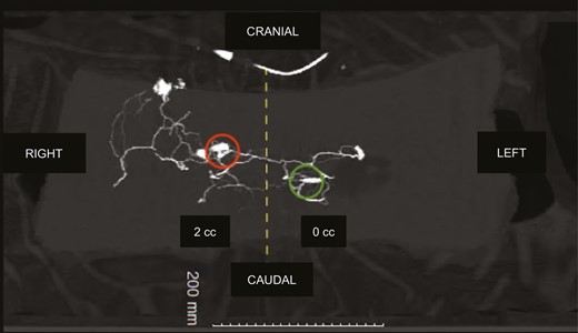 Three-dimensional computed tomographic angiography: flap no. 2, right PSAP = 2 mL, left PSAP = 0 mL. Same findings for flap no. 1: preferential flow towards the iliac crests, contrast medium is leaking through the lumbar perforating network, diffusing to the contralateral side. Red circle, right PSAP catheter; green circle, left PSAP catheter. PSAP, parasacral artery perforator.