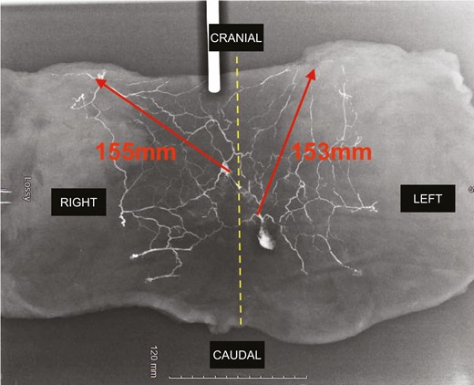 Final X-ray. Red arrows indicate the maximum length from the parasacral artery perforator perforasome to the adjacent perforasome.