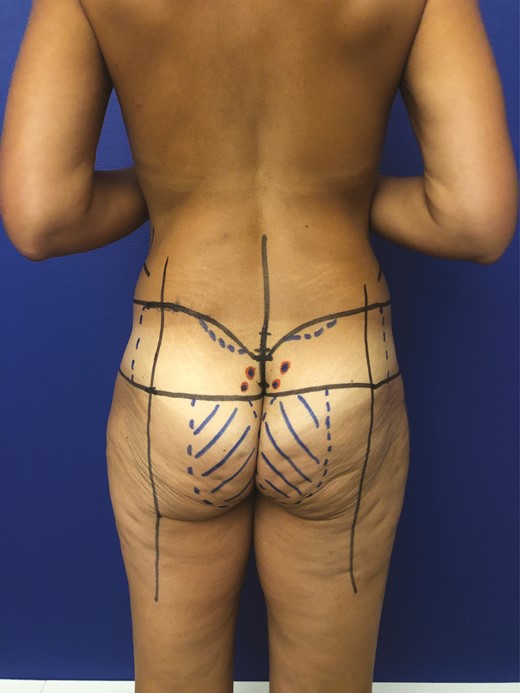 Preoperative drawing for gluteal augmentation with parasacral artery perforator propeller flap for a 50-year-old female patient.