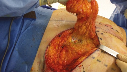 Intraoperative photograph of harvesting and undermining a flap before it was buried in its pocket.