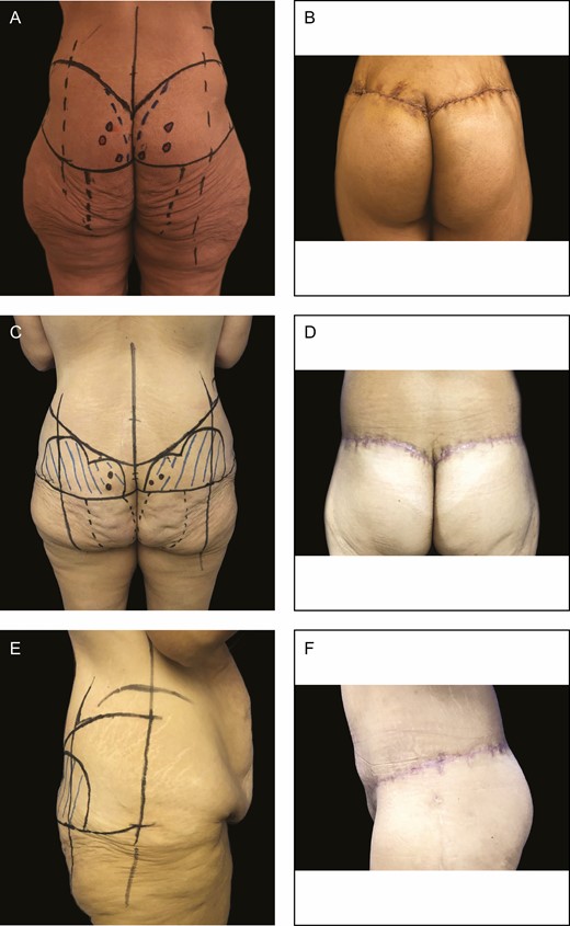 (A) Preoperative and (B) 2-month postoperative results after parasacral artery perforator gluteal augmentation flap for a 46-year-old female patient. (C) Preoperative and (D) 2-month postoperative results after surgery for a 41-year-old female patient. (E, F) Side views of the same 41-year-old female patient 2 months after surgery.