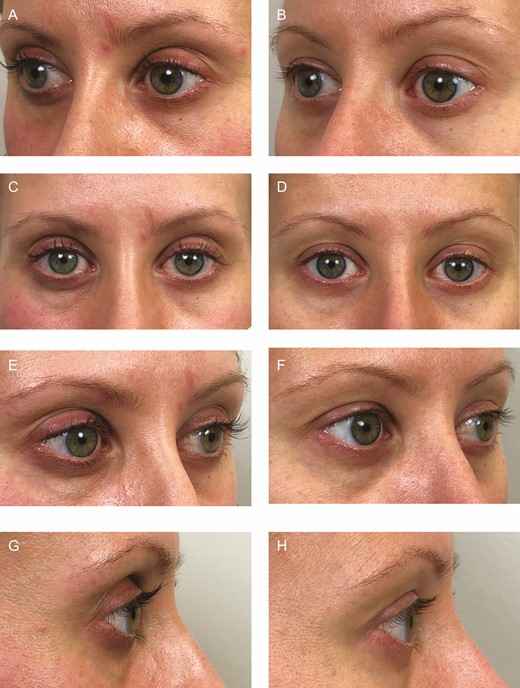 Color photographs of a 35-year-old female after taking prostaglandin analogue lash lengtheners for 10 months (A, C, E, G), and 6 months after stopping treatment (B, D, F, H). The left oblique (A, B), frontal (C, D), right oblique (E, F), and right lateral (G, H) views are presented.