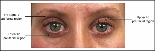 Color photograph of reported case of a 35-year-old female (after 10 months of PGALL treatment) used as an example image to illustrate the 3 regions with most marked volume loss in this study. Highest mean scores were: 1.20 (out a maximum total of 2.0) in the upper lid preseptal/sub-brow region; upper lid pretarsal region (1.20); and lower lid pretarsal region (1.13). To demonstrate the use of the outlined grading system (Table 1) with our reported case (Figure 1), readers might assume that this female patient’s appearance before starting a PGALL was similar to that seen in Figure 1D (frontal view, which was actually taken 6 months after stopping PGALL, when the patient reported a 90% to 95% resolution of her periocular changes). By looking at this image alongside Figure 1C (frontal view, taken after 10 months of PGALL treatment) we can construct an ad hoc “before-and-after” image pair, which we can grade (for demonstration purposes only) for periorbital fat/volume loss. In this case, the image pair would have been given a grading score of 6 (out of 19), as outlined. Upper lid = 3: preseptal = 2 (preseptal/central sub-brow skin appears less full, and there is hollowing of the superior sulcus, associated with increased skin fold height and an increase in lid show); pretarsal = 1 (pretarsal skin appears less full); lateral sub-brow region = 0 (no significant change); brow = 0 (no significant change). Lower lid = 2: pretarsal = 1 (pretarsal skin appears less full); tear trough = 0 (no significant change); lid-cheek junction = 0 (no significant change); lower lid height = 0 (no significant change); rhytids = 1 (increase in number of evident rhytids). Medial canthus = 1: medial canthal tendon = 1 (increased reveal of medial canthal tendon). Lateral canthus: orbital rim = 0 (no significant change); lateral raphe region = 0 (no significant change). PGALL, prostaglandin analogue lash lengthener.