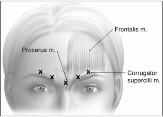 Single-dose, 5-point intramuscular injection pattern.