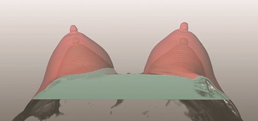 A screenshot of the Lipovol method where fat graft volume retention is measured.