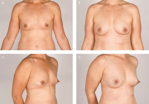 Clinical photographs of participant 7, a 40-year-old female. The fat graft volume retention was 81% in the breast treated with placebo (right breast) and 83% in the adipose-derived stromal cell–treated breast (left breast).
