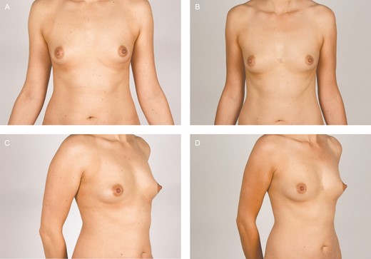 Clinical photographs of participant 9, a 30-year-old female. The fat graft volume retention was 14% in the breast treated with placebo (right breast) and 14% in the adipose-derived stromal cell–treated breast (left breast) after 12 months.