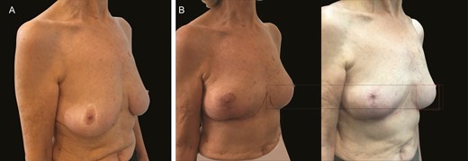 (A) Preoperative image of this 70-year-old female patient with previous mastopexy. (B) Postoperative images following revision mastopexy with mesh at 3 months and 36 months illustrate extreme stability at 36 months with virtually no descent of the lower pole over time.