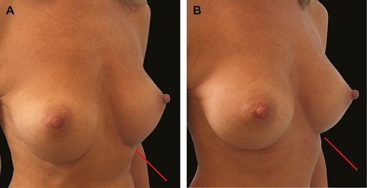 (A) Three-quarter view of this 29-year-old female patient shows bottoming out following breast augmentation with 275-cc round textured implants and failed capsulorrhaphy. (B) Six-month postoperative image illustrates stable fixation of inframammary fold with GalaFLEX reinforcement 1 year postoperatively.