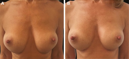 (A) Preoperative and (B) 6-month postoperative anterior view of the 29-year-old female patient shown in Figure 11.