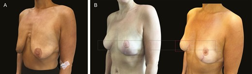 (A) Preoperative massive weight loss in this 52-year-old female patient (40-kg weight loss) wanting mastopexy but no implant. (B) Three-month and 1-year postoperative images illustrate stability throughout even in the absence of implants.