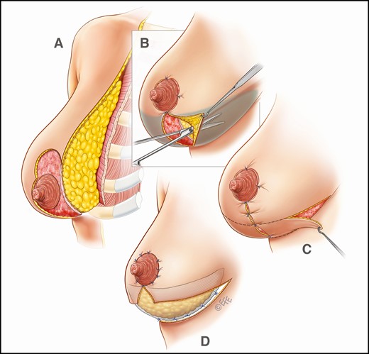 Operative sketches illustrating mastopexy technique (without implants), including insertion of GalaFLEX mesh.