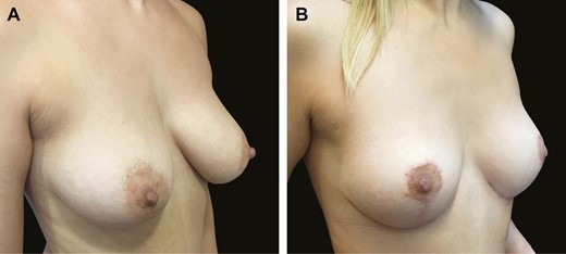 Typical mastopexy result in this 38-year-old female patient shown (A) before and (B) 6 months after surgery, illustrating extremely stable lower pole position.