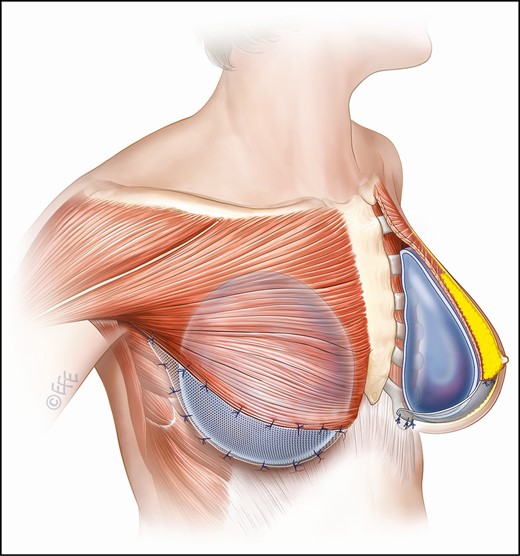 Diagram illustrating mesh placement when GalaFLEX is employed for augmentation/mastopexy. The thin black line represents the mesh supporting the implant, sutured form the lower border of the pectoralis muscle to the chest wall posteriorly.