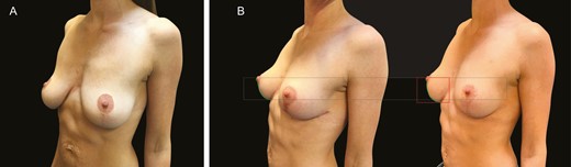 (A) Preoperative image of this 42-year-old female patient with a previous mastopexy without mesh. (B) The image on the left illustrates the same patient 3 months post revision, and the image on the right is one year postoperatively. The black rectangle represents nipple to fold height at 3 months, and the red rectangle represents the nipple to fold height at 1 year. The difference between these measurements equals the percentage increase in fold descent. The green line represents the curve length from nipple to IMF at 3 months and 1 year, minus the percentage increase between these time points equals the lower pole stretch over time.