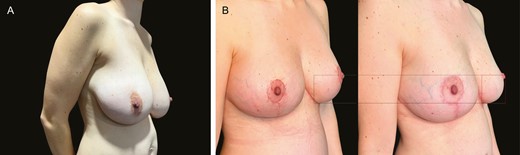 (A) Preoperative image of breast reduction in this 31-year-old female patient. (B) The image on the left is the patient 3 months after a moderate breast reduction (420 g) and the right is 1 year postoperatively.