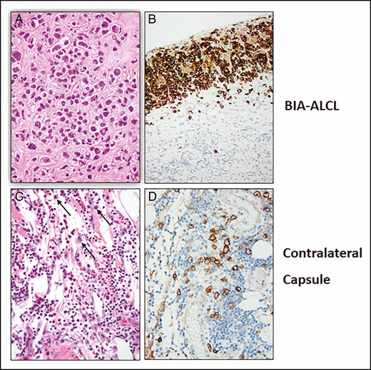 Hematoxylin and eosin–stained sections of tumor cells surrounded by dense fibrosis (A, B) and the contralateral capsule with inflammation and scattered large, atypical cells (black arrows) (C, D). Immunohistochemical demonstration of CD30 in tumor cells (B) and large, atypical cells in the contralateral capsule (D).
