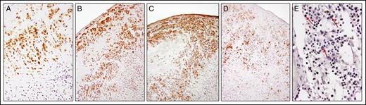 Immunohistochemistry analysis of pSTAT3 (A), pSTAT6 (B), interleukin 9 (C), and granzyme B (D) in tumor cells. Absence of staining of large, atypical cells (red arrows) for pSTAT3 (E) in the contralateral capsule. pSTAT3, phosphorylated STAT3.