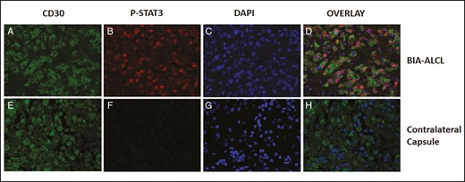 CD30 and pSTAT3 coexist in tumor cells but not in the large, atypical, CD30+ cells in the contralateral capsule. Immunofluorescence staining of CD30 and pSTAT3 in tumor cells (A-D) and large, atypical cells in the contralateral capsule (E-H). Breast implant–associated anaplastic large cell lymphoma immunofluorescence for CD30 (green; A and E), nuclear pSTAT3 (red; B and F), and co-stained for 4′,6-diamidino-2-phenylindole (blue; C and G). CD30+ tumor cells stain for both nuclear pSTAT3 and 4′,6-diamidino-2-phenylindole focally yielding purple color (D). Small lymphocytes stain for 4′,6-diamidino-2-phenylindole (blue) but not CD30 (H). pSTAT3, phosphorylated STAT3.