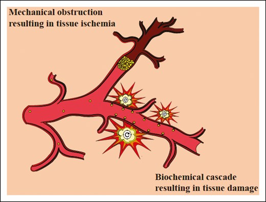 In the macroscopic pathway mechanical obstruction by fat causes tissue ischemia and immediate symptoms. In the microscopic pathway there is no obstruction, but a biochemical cascade is initiated by fat particles and leads to surrounding tissue damage and delayed symptoms.