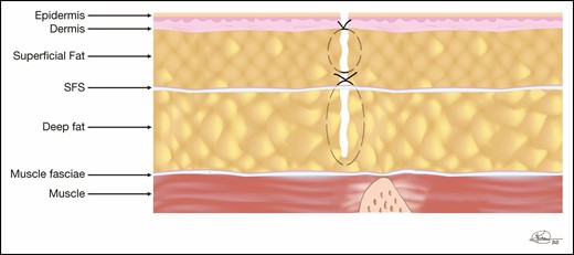The back closure in a belt lipectomy is shown in this diagram. The deep layer incorporates the small amount of fat left on the underlying muscle and both the superior and inferior superficial fascial system (SFS). The superficial closure spans from the SFS to the subdermis, closing as much dead space as possible.