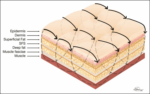 External netting sutures are placed through the skin and reach the underlying muscle fascia, usually placed in a running fashion, and are left in place between 3 to 4 days to prevent stitch marks if left in longer. They cover the entire area operated on to close dead space and prevent fluid accumulation as well as contract skin to the underlying anatomy. SFS, superficial fascial system.