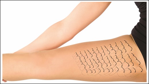 An example of the utilization of “external netting” is shown in this diagram. After the medial thighs are liposuctioned and the surgeon wants to increase the contraction of the skin and prevent fluid accumulation, external netting can be utilized. External netting can be employed with closed procedures such as the one shown here as well as open procedures such as facelifts, open gynecomastia procedures, etc. In the case of thigh reduction surgery, the netting would only involve the surface area that has been operated on.