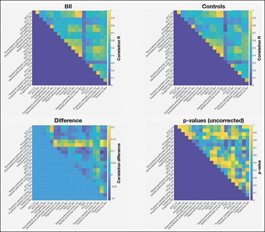 Functional connectivity results for the BII group, control group, and difference between the groups. ACC, anterior cingulate cortex; BII, breast implant illness; MCC, mid-cingulate cortex; PAG, periaqueductal grey; PCC, posterior cingulate cortex; LH, left hemisphere; RH, right hemisphere.