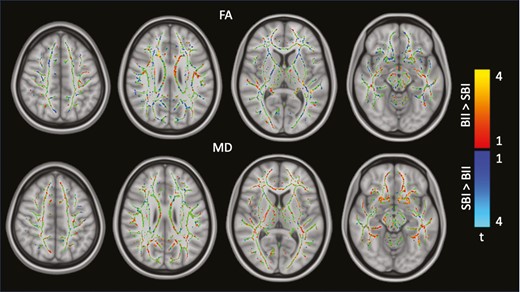 Group differences in diffusion tensor imaging–derived measures: FA (top) and MD (bottom). BII, breast implant illness; FA, fractional anisotropy; MD, mean diffusivity; SBI, silicone breast implant.