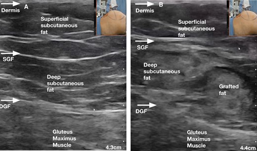 (A) Ultrasound image demonstrating the anatomic layers of the gluteal region prior to any infiltration of fat graft. (B) Ultrasound image demonstrating the anatomic layers of the gluteal region after injection of fat graft below the SGF into the “deep subcutaneous fat layer”, with preservation of the DGF (bottom arrow). DGF, deep gluteal fascia (ie, gluteus maximus muscle fascia); SGF, superficial gluteal fascia (ie, superficial fascial system).