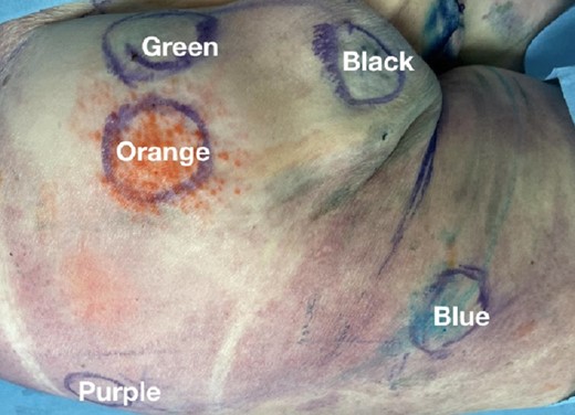 Marked injection sites of dye mixed with saline into the deep subcutaneous layer (below the superficial gluteal fascia), with their respective colors, in the cadaver hemibuttock (above).