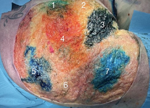 The distinct deep fat compartments of the buttocks after removal of the skin and superficial layer of fascia. These comprise: 3 medial compartments (1, superior-medial; 2, middle-medial; 3, inferior-medial); a central compartment (4); and 3 lateral (5, superior-lateral; 6, middle-lateral; 7, inferior-lateral) deep fat compartments.