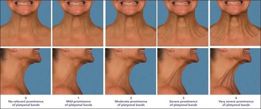 Geister validated assessment scale for platysmal bands (from left to right): Patient in the standard anatomical position anterior and right lateral view of “no relevant prominence of platysmal bands” or 0 on the scale; patient in the standard anatomical position anterior and right lateral view of “mild prominence of platysmal bands” or 1 on the scale; patient in the standard anatomical position anterior and right lateral view of “moderate prominence of platysmal bands” or 2 on the scale; patient in the standard anatomical position anterior and right lateral view of “severe prominence of platysmal bands” or 3 on the scale; and patient in the standard anatomical position anterior and right lateral view of “very severe prominence of platysmal bands” or 4 on the scale.28 Reproduced with permission from Geister TL et al 2013.