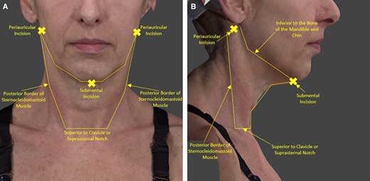 Treatment area and incisions: R/L periauricular incision and submental incision. (A) Patient in the standard anatomical position anterior view with graphics showing the treatment area and incisions. (B) Patient in the standard anatomical position right lateral view with graphics showing the treatment area and incisions.