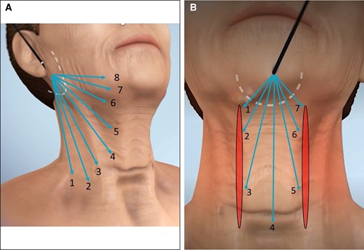 Illustration of strokes and passes for helium plasma treatment. (A) Three-dimensional generated anatomical model right oblique view illustrating the strokes and passes for helium plasma treatment. Produced by Canfield Scientific (Parsippany, NJ). (B) Three-dimensional generated anatomical model anterior view illustrating strokes and passes for helium plasma treatment. Produced by Canfield Scientific.