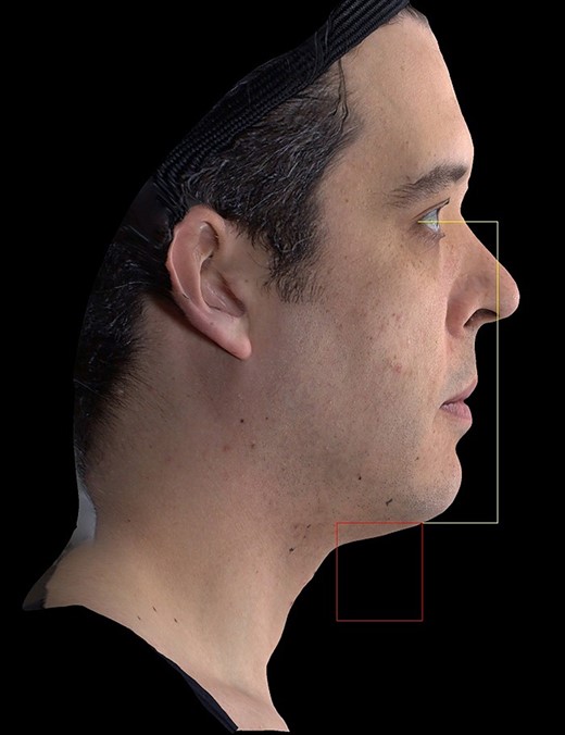 Quantitative assessment of submental area. Produced by Canfield Scientific (Parsippany, NJ).