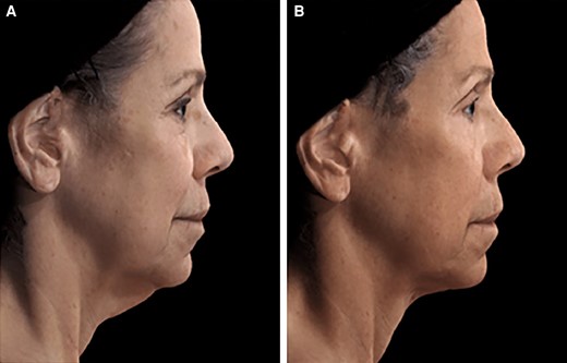 A 65-year-old female patient seeking improvement for lax tissue in the neck and submental region who underwent helium plasma treatment only. (A) Patient in standard anatomical position right lateral view preoperative image. (B) Patient in standard anatomical position right lateral view postoperative image taken at Day 180 follow-up visit.