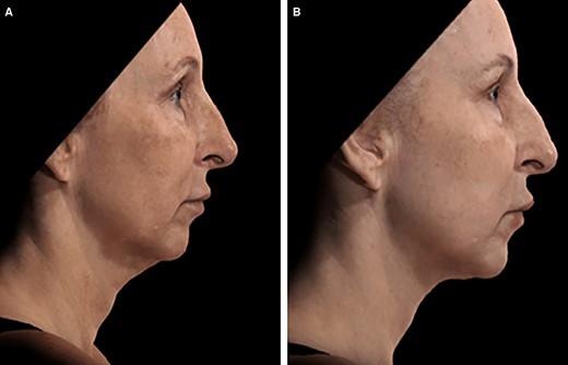 A 58-year-old female patient seeking improvement for lax tissue in the neck and submental region who underwent helium plasma treatment only. (A) Patient in standard anatomical position right lateral view preoperative image. (B) Patient in standard anatomical position right lateral view postoperative image taken at Day 180 follow-up visit.