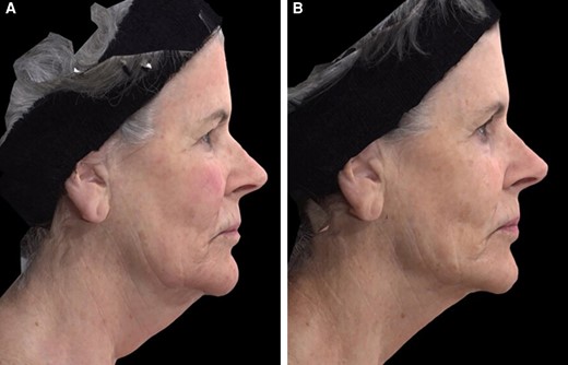 A 63-year-old female patient seeking improvement for lax tissue in the neck and submental region who underwent helium plasma treatment only. (A) Patient in standard anatomical position right lateral view preoperative image. (B) Patient in standard anatomical position right lateral view postoperative image taken at Day 180 follow-up visit.