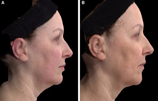 A 52-year-old female patient seeking improvement for lax tissue in the neck and submental region who underwent helium plasma treatment only. (A) Patient in standard anatomical position right lateral view preoperative image. (B) Patient in standard anatomical position right lateral view postoperative image taken at Day 180 follow-up visit.