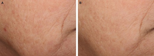 Representative images of VYC-12L–related improvements in cheek skin smoothness and fine lines. (A) Participant is shown at baseline before treatment and (B) 1 month after VYC-12L treatment. The participant was a 51-year-old White female participant with baseline ACSS and AFLS scores of 3 and 4, respectively, on the right cheek. The participant received 1.8 mL of VYC-12L for the initial treatment and 0.9 mL for touch-up treatment in the right cheek. At the 1-month posttreatment follow-up, the participant had ACSS and AFLS scores of 2 and 3, respectively, on the right cheek. ACSS, Allergan Cheek Smoothness Scale; AFLS, Allergan Fine Lines Scale.