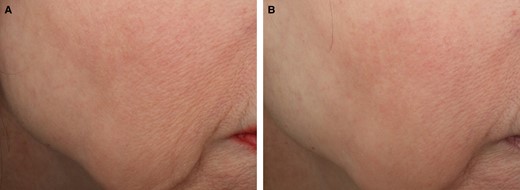 Representative images of VYC-12L-related improvements in cheek skin smoothness and fine lines. (A) Participant is shown at baseline before treatment and (B) 1 month after VYC-12L treatment. The participant was a 63-year-old White female participant with baseline ACSS and AFLS scores of 2 on the right cheek. The participant received 1.8 mL of VYC-12L for the initial treatment and 0.8 mL for touch-up treatment in the right cheek. At the 1-month posttreatment follow-up, the participant had ACSS and AFLS scores of 1 on the right cheek. ACSS, Allergan Cheek Smoothness Scale; AFLS, Allergan Fine Lines Scale.