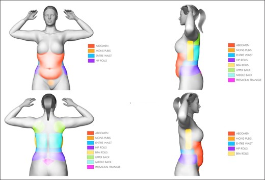 Treatment with 360° liposuction includes the following 8 areas: the abdomen, mons pubis, waist/flanks, hip rolls, bra rolls, upper back, middle back, and presacral triangle.
