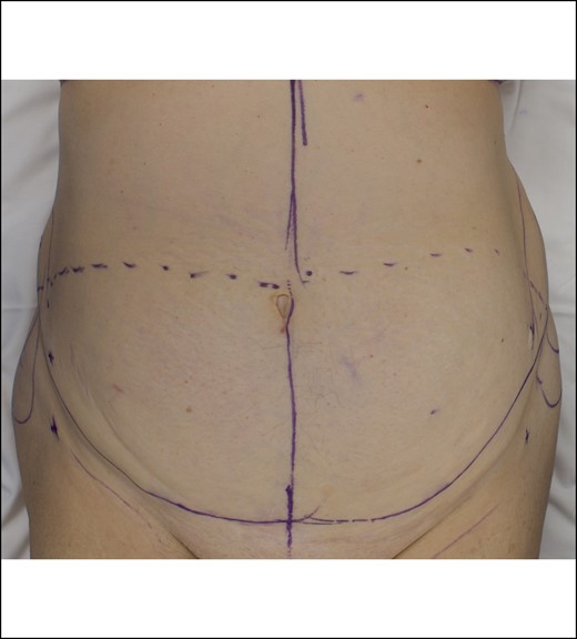 Typical preoperative abdominoplasty markings demonstrated on a 66-year-old female patient. Inferior incision designed below the abdominal skin crease at the superior border of the pubic hairline and extended laterally.