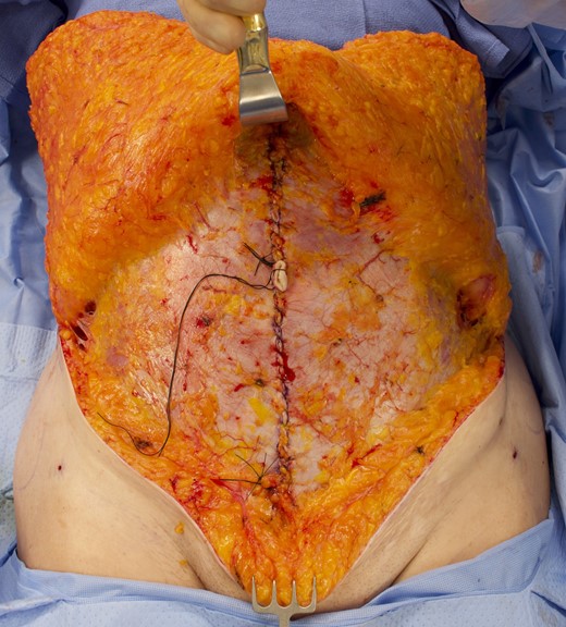 Intraoperative photograph of the same 66-year-old female patient shown in Figure 1. Prefascial dissection performed centrally to the level of the xiphoid process. Plication to address diastasis recti utilized running nonabsorbable suture.