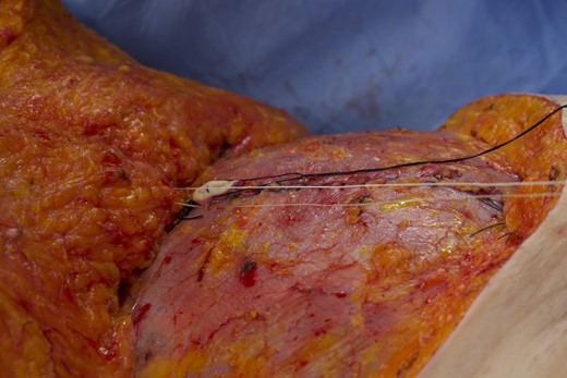 Intraoperative photograph of the same 66-year-old female patient. A series of 4 PTS sutures were placed to anchor Scarpa's fascia to the abdominal wall fascia at the base of the umbilicus. The umbilical stalk was only anchored to the flap skin.