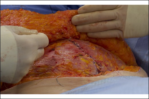 Intraoperative photograph of the same 66-year-old female patient. Sutures in the midline were placed under controlled tension to advance the flap caudally and obliterate the space typically evacuated by drains. A hallmark of a PTS suture correctly placed through Scarpa's fascia is that the suture alone advances the flap, without the need for the surgeon or assistant to push the flap down.
