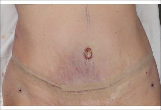Intraoperative photograph of the same 66-year-old female patient. Umbilicus inset with a stirrup-shaped incision at the level of the iliac crest. Scarpa's fascia around the perimeter of the umbilical tunnel was attached to the abdominal wall fascia.