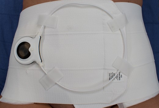 Intraoperative photograph of the same 66-year-old female patient. Dressings included a pulsed electromagnetic field therapy device (SofPulse) applied external to the binder.